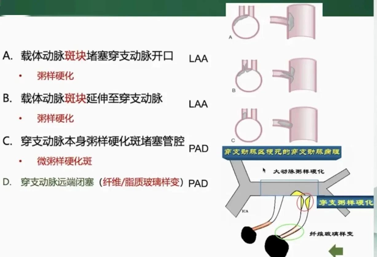 缺血性卒中治疗原则,缺血性卒中病因分型