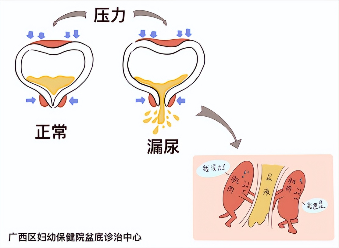 一招教你解决漏尿,一招教你改善漏尿