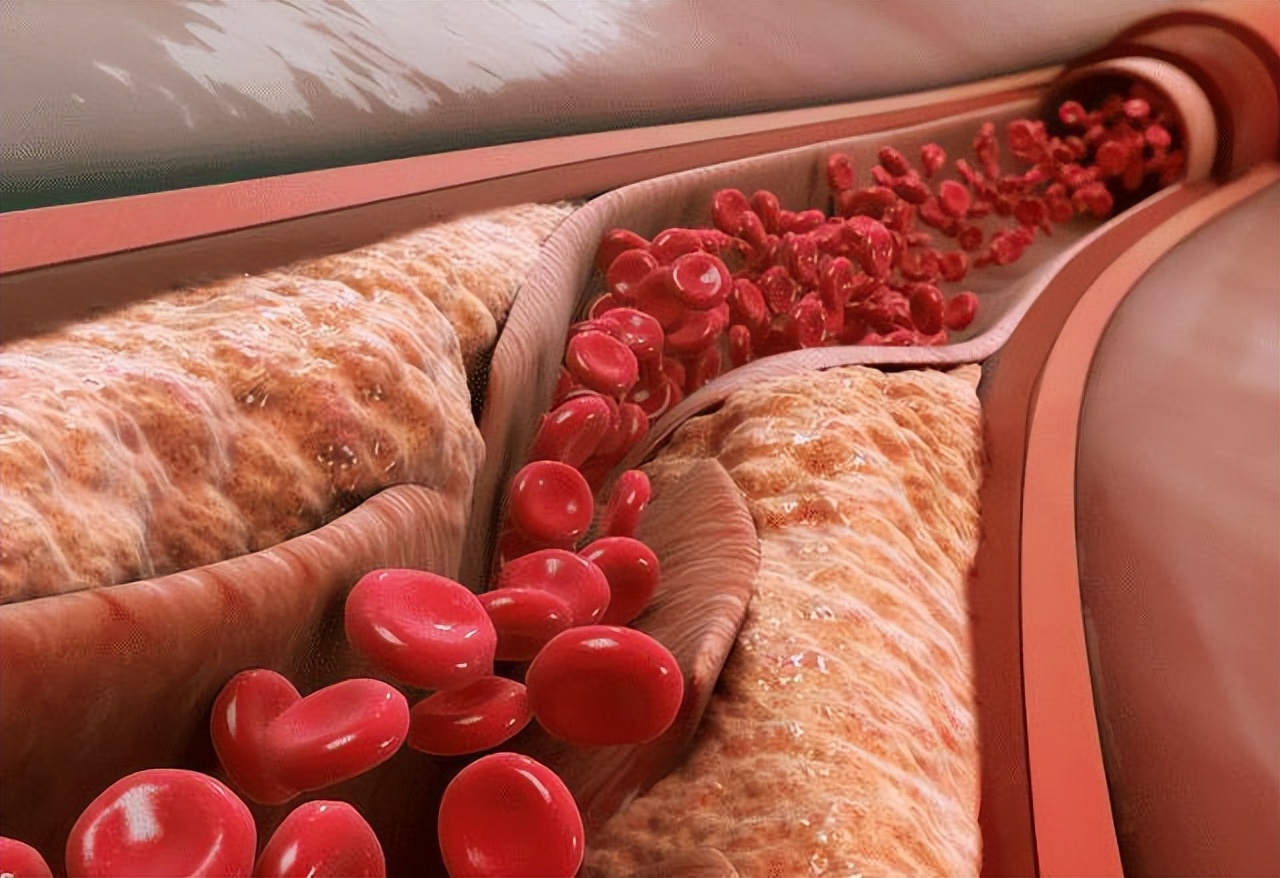 吃深海鱼油对血管狭窄有帮助吗,醋红酒鱼油是否能软化血管