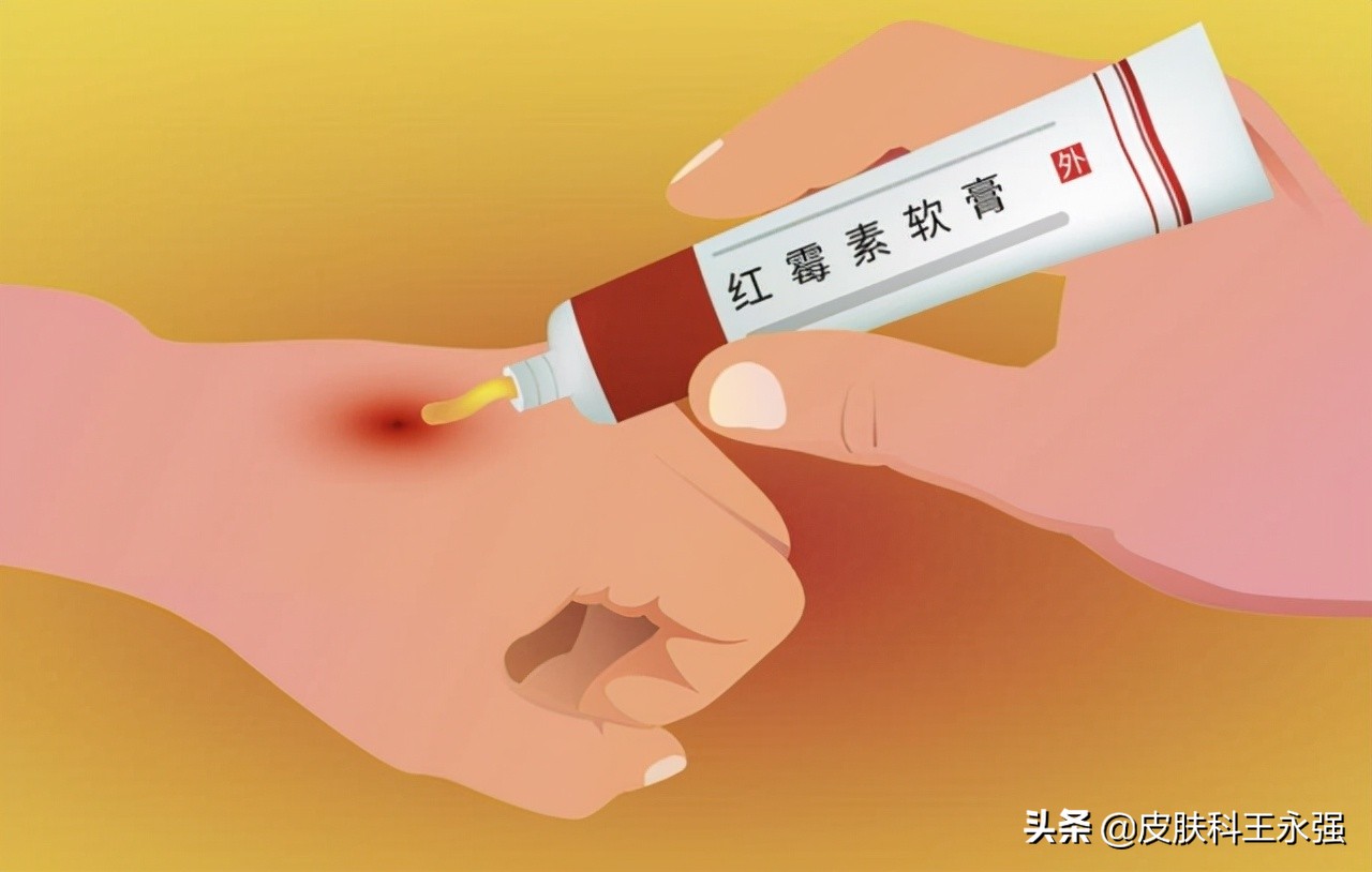 1块钱的红霉素软膏功效多,主要用于治疗什么?这5个小毛病能解决