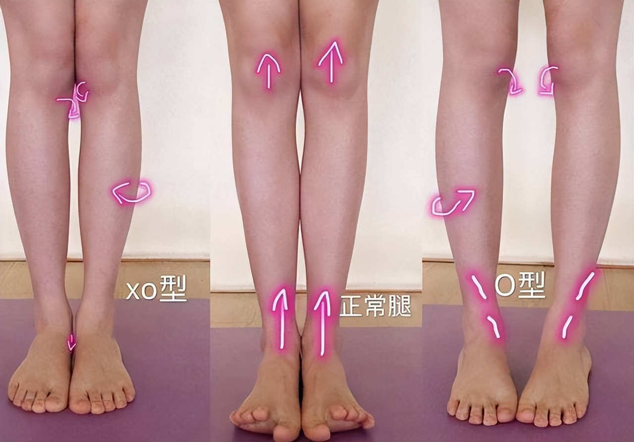 一岁左右小孩o型腿能纠正过来吗,孩子腿严重变形