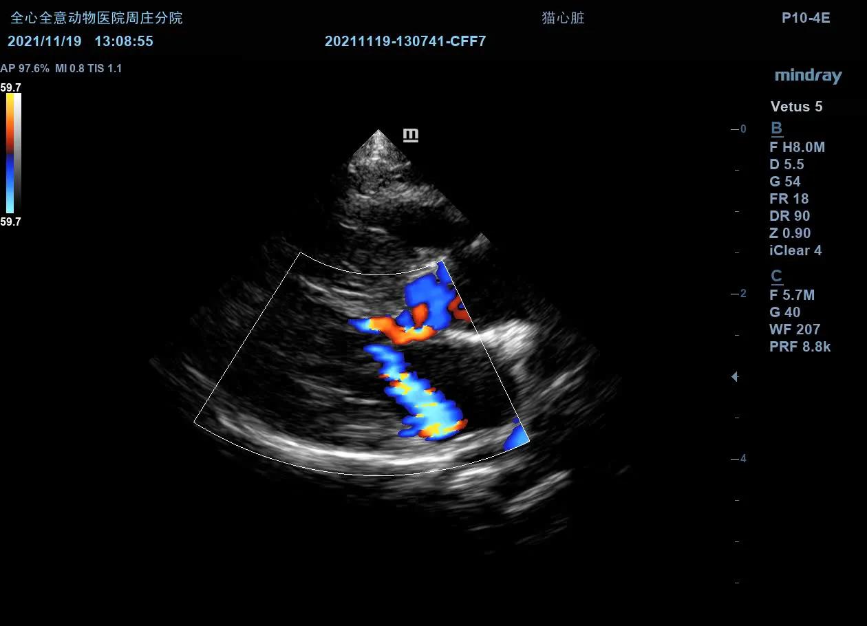 二尖瓣发育不良病例总结