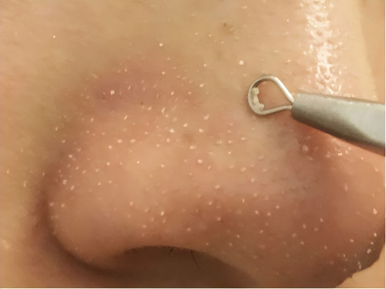 真黑头假黑头傻傻分不清楚，怎么去黑头？