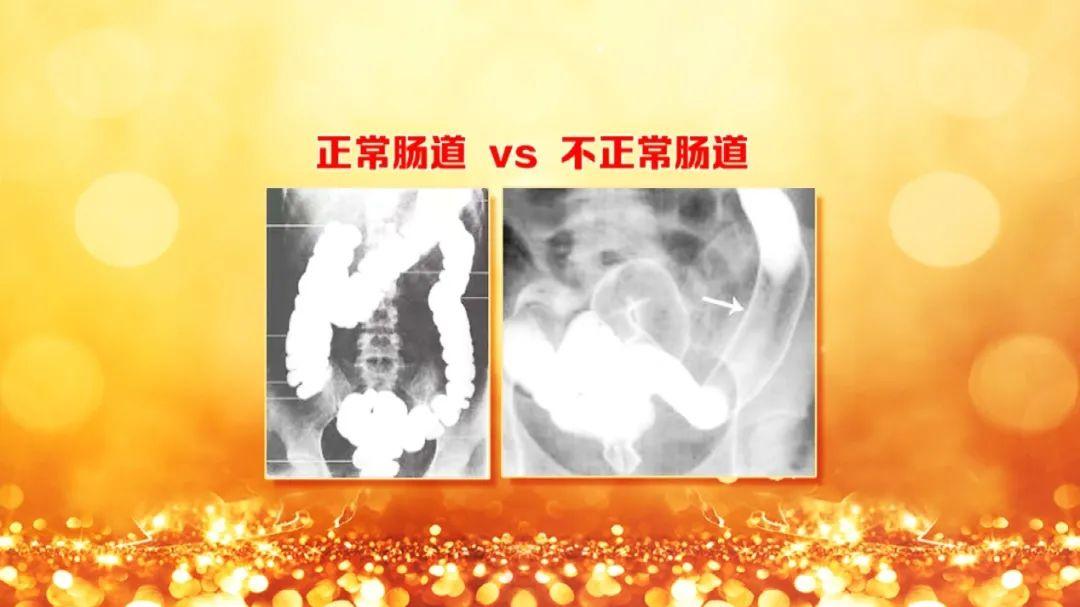 肠炎不治有什么后果,怎么防止慢性肠炎变癌