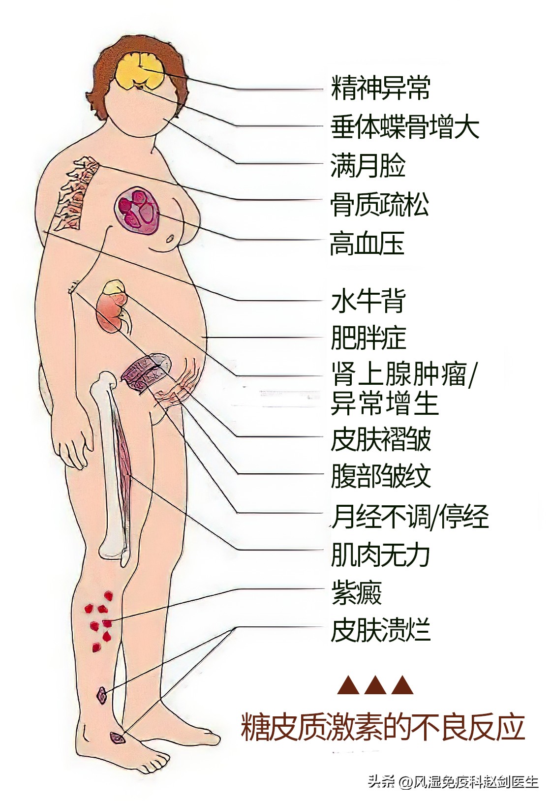 类风湿性关节炎用什么激素好,类风湿关节炎必须用活血药吗