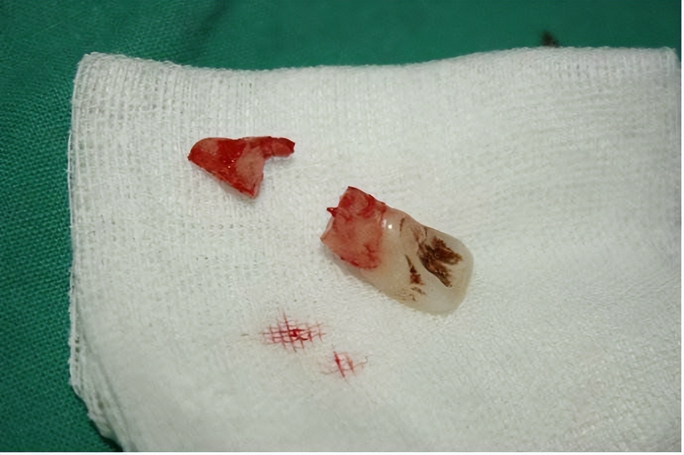 牙齿断了一半怎么处理最好多少钱,牙齿断了一半怕冰怎么处理最好