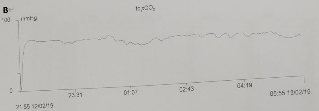 几十年间歇性胸闷气短去哪治疗,胸闷气短三年了怎么回事