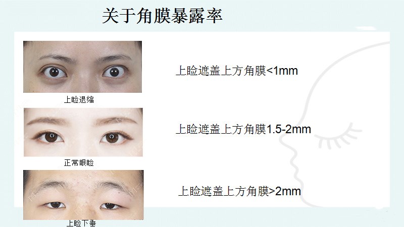 平行双眼皮和开扇形哪个更好看,平行双眼皮变成扇形双眼皮