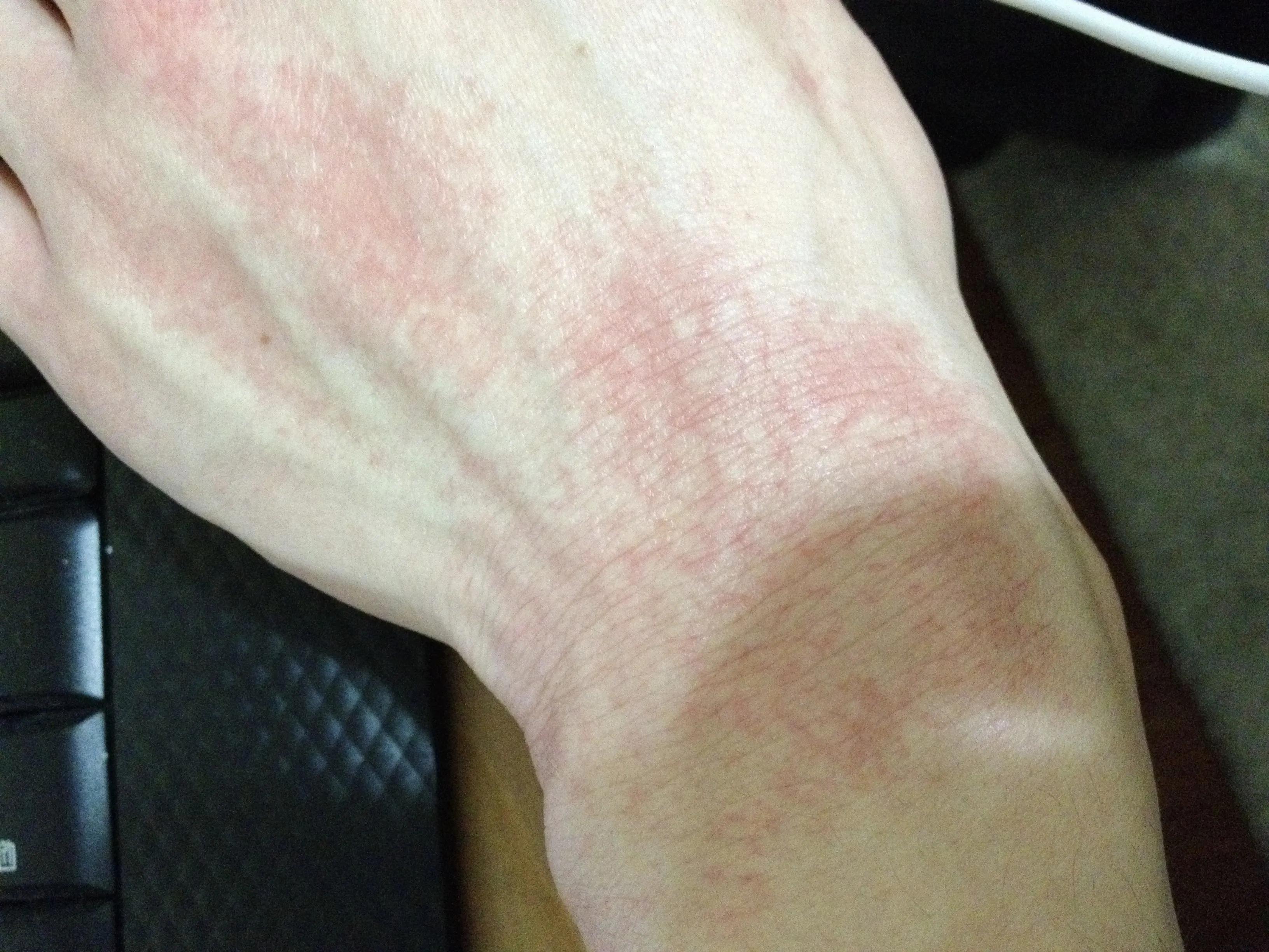 手碰到山药为什么会很痒