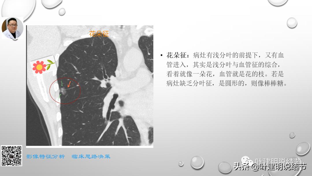 在《一脉阳光》呼吸影像诊断专题培训班上的讲课PPT（第一部分）