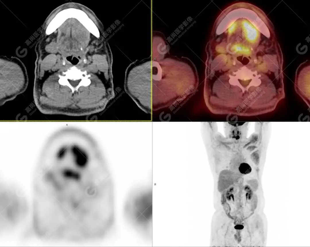 肺部结节确诊是癌如何治疗,肺结节疑似早期恶性肿瘤