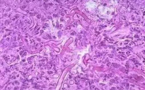 阴道炎到宫颈炎的演变及诊治策略