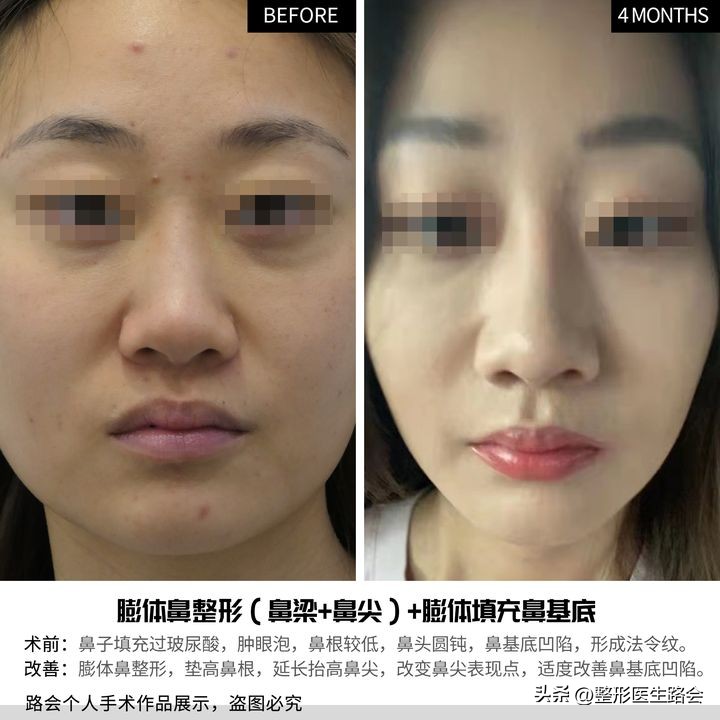 膨体隆鼻6年亲身经历,膨体隆鼻一年后的真实感言