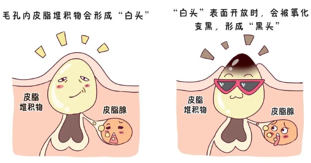 去黑头最佳有效的方法,如何简单有效的去黑头