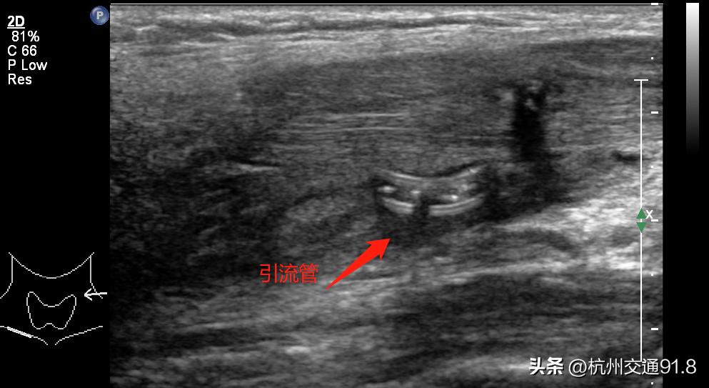 杭州小伙吃完烧烤脖子痛，以为“上火”了，结果是个大“漏”！