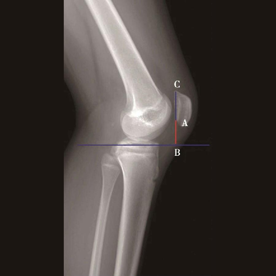 髌骨骨折评估,髌骨上下滑动评估什么内容
