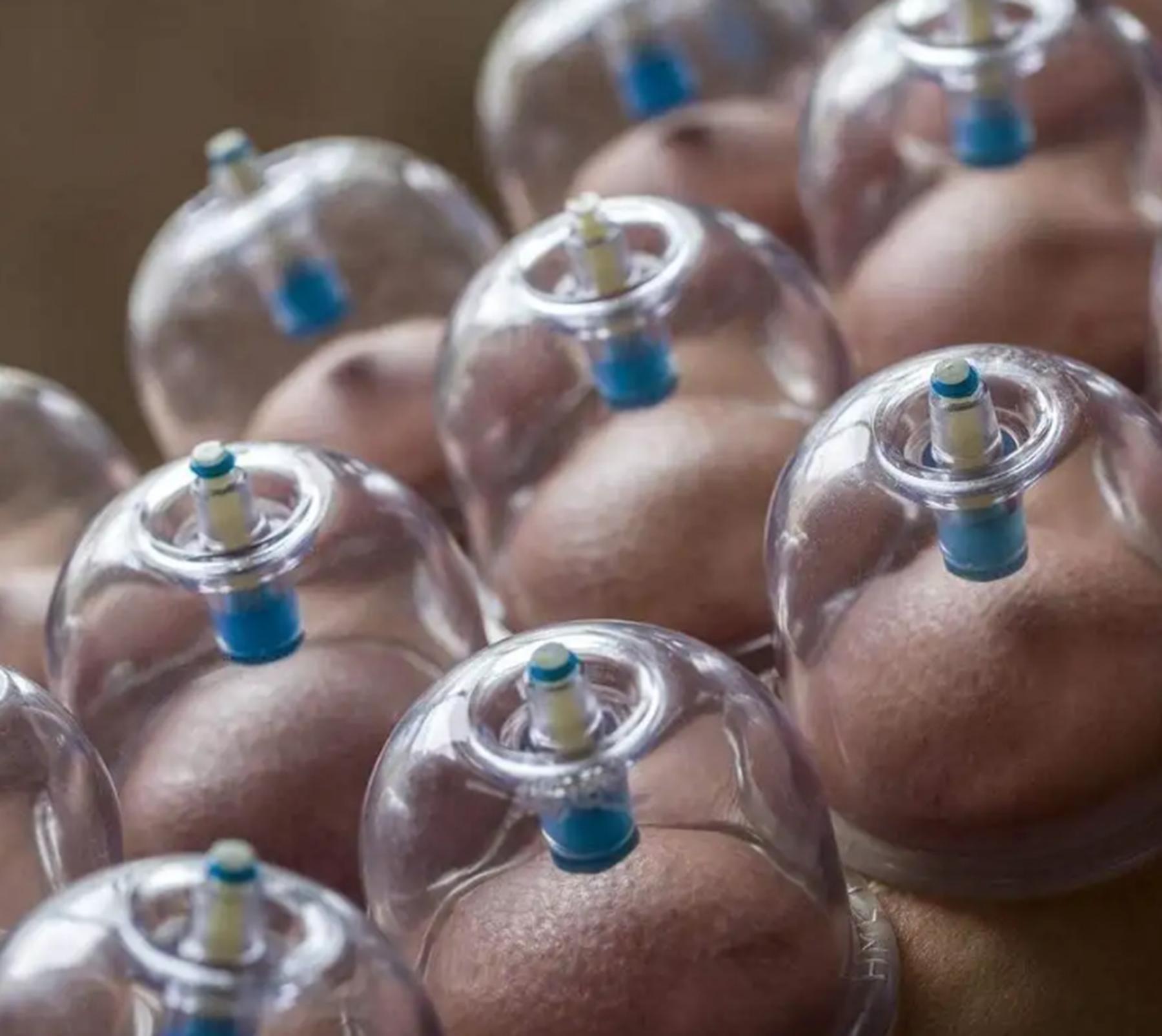 女子拔罐二度烧伤后续,女子拔火罐被烧伤后续