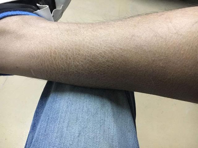 冬天来了皮肤干燥脱衣服有皮屑,冬天皮肤很干燥全是皮屑