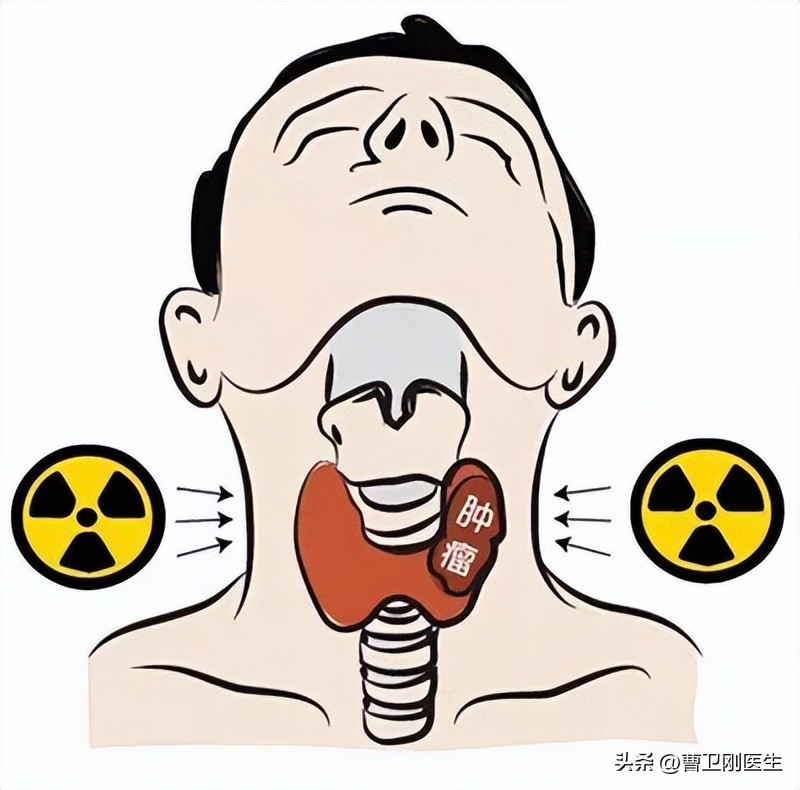 甲状腺癌中期术后碘131还能活多久,甲状腺癌术后碘131治疗能活多久