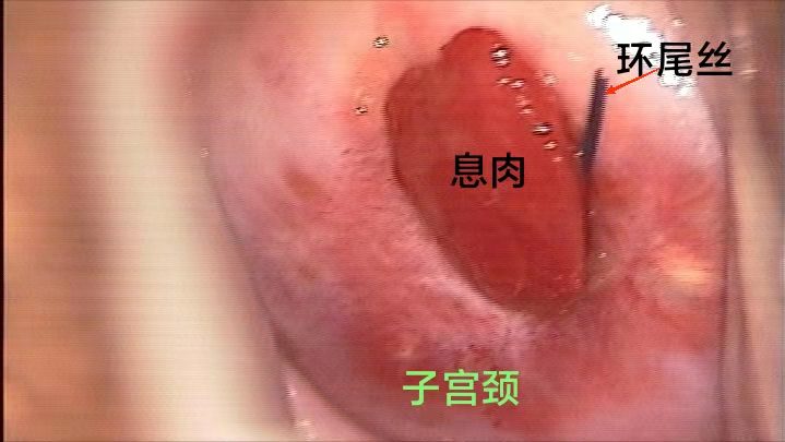 不同部位的多发息肉如何取病理,身上多处长息肉是怎么回事