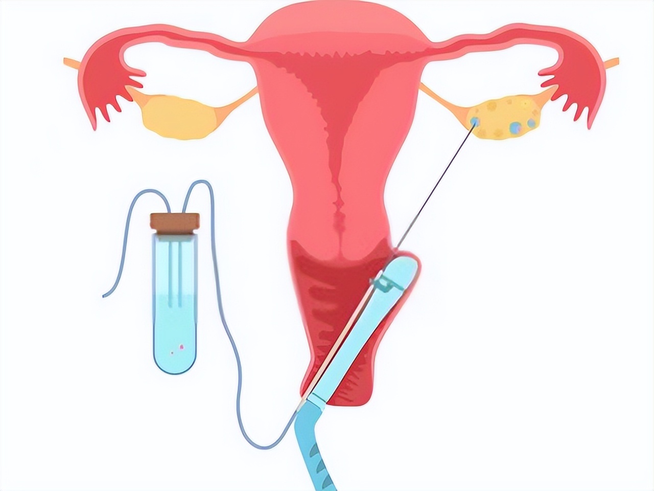 三次试管婴儿移植都失败了怎么办,三次试管失败怎么办钱也花完了