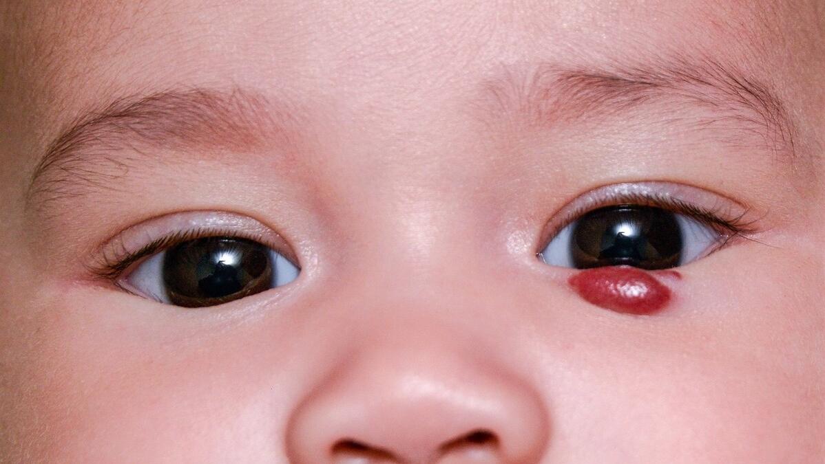 血管瘤要怎么治疗效果才最好,发现血管瘤怎么治疗好