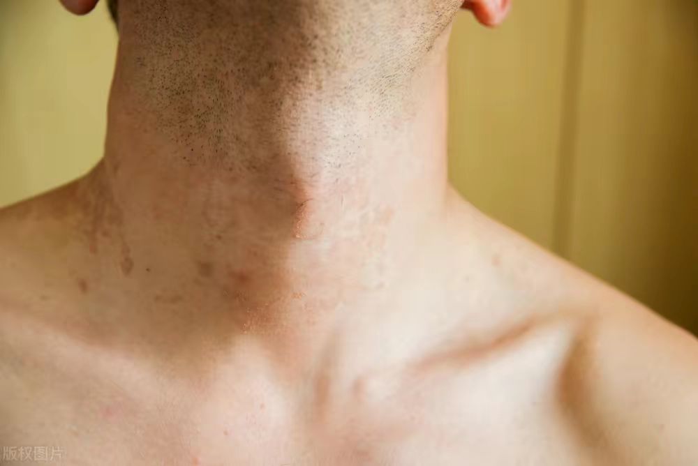 神经性皮炎能彻底治愈,神经性皮炎能彻底根治吗