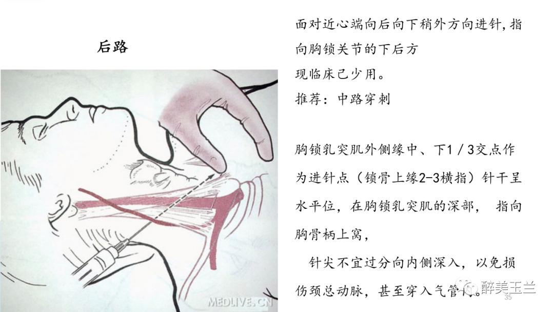 深静脉穿刺置管术讲解ppt,中心静脉穿刺置管深度