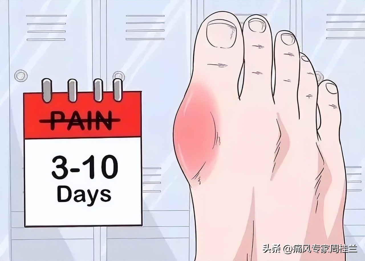 尿酸不高但有痛风症状怎么办,尿酸超标晚上睡觉有什么症状