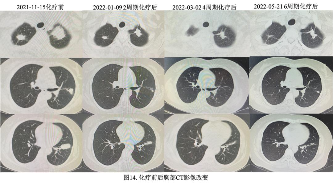 妇女双肺多发结节，病理示炎症，病情持续进展如何揭疑？