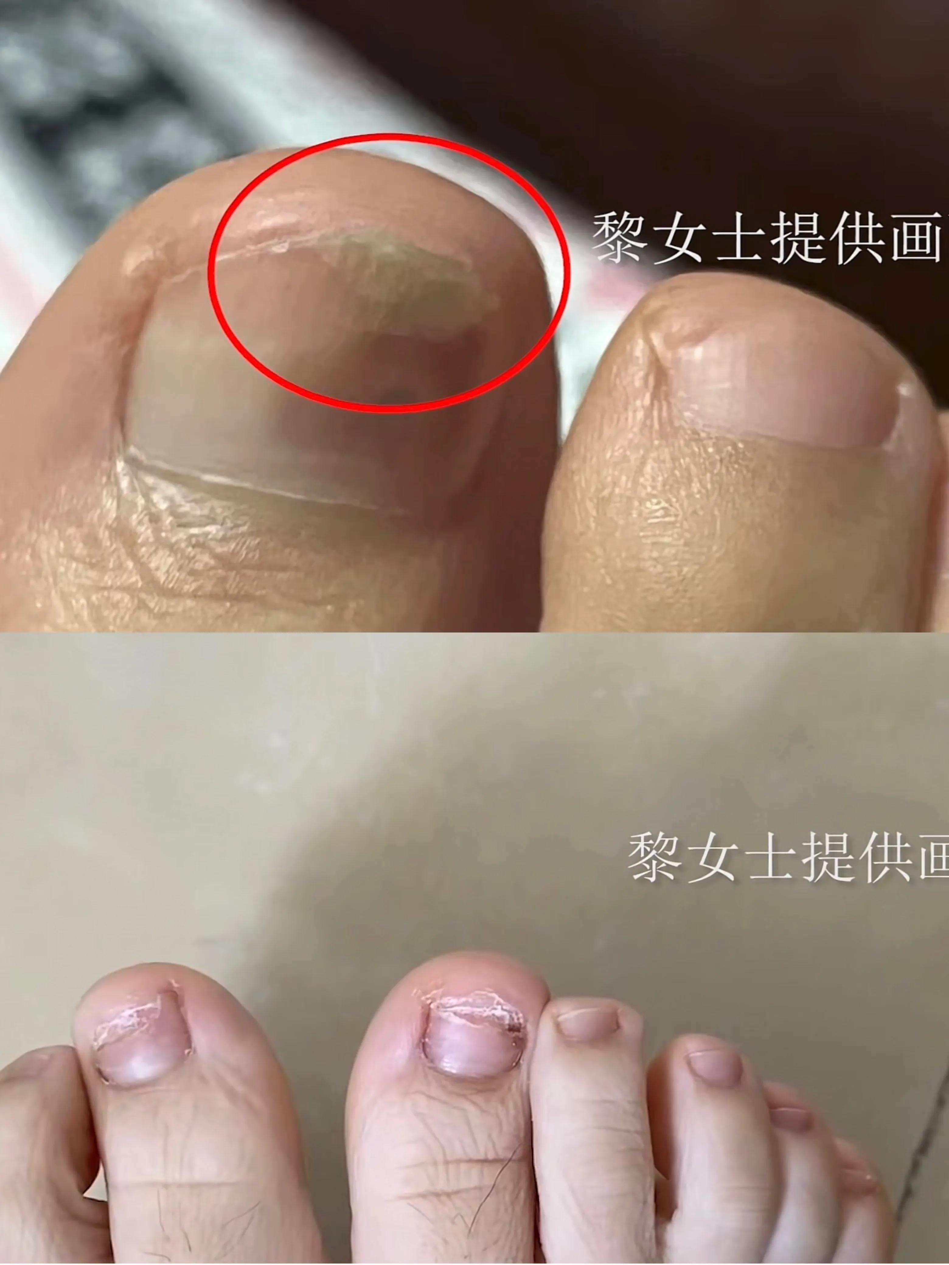 广东广州：一女子做完美甲后，发现指甲里面总是有黑黑的东西。