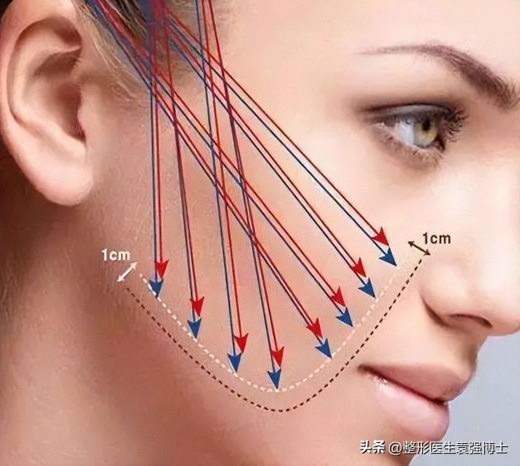 脸部下垂法令纹最有效的办法,改善脸部下垂法令纹最好的方法