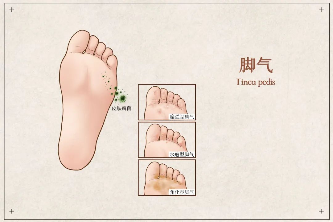 一到夏天脚气总复发怎么办呢,一到夏季脚气怎么消除
