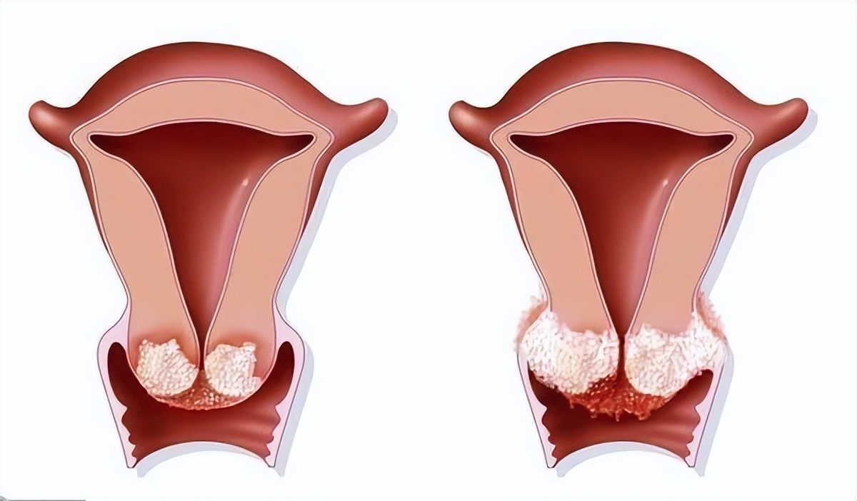 美国女子患宫颈癌晚期，散发臭味迷晕23名医护人员，却难找到原因