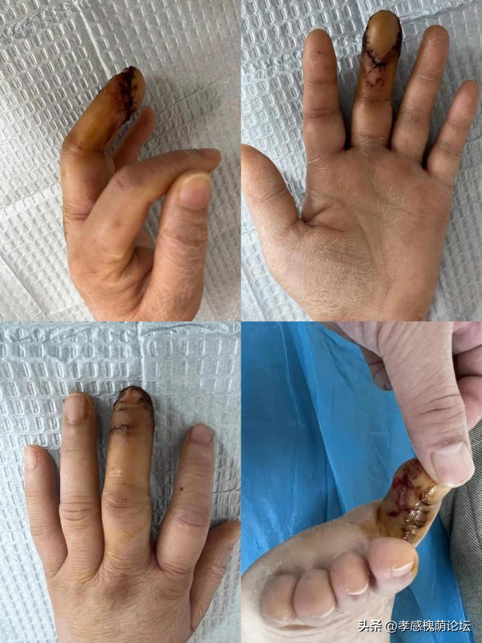 移花接木破绽,手指移花接木术