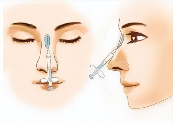 上海九院韦敏隆鼻,九院韦敏技术怎么样