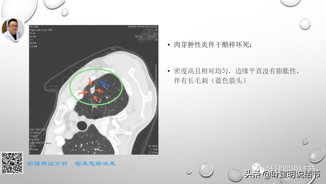 在《一脉阳光》呼吸影像诊断专题培训班上的讲课PPT（第一部分）