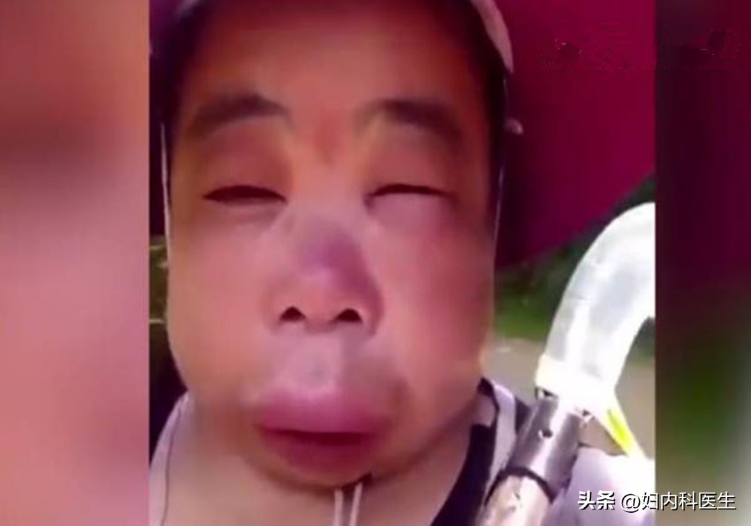 户外被蜂螫后该如何急救,被蜜蜂螫伤了怎么办