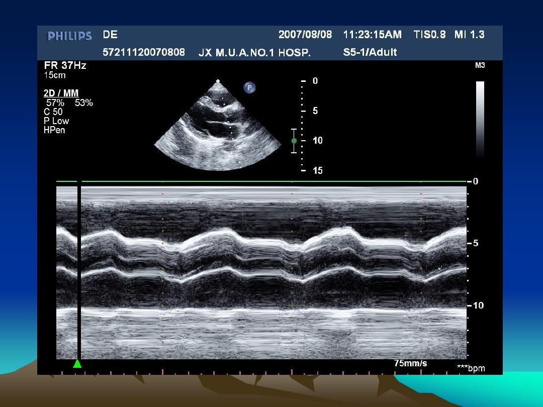 医生科普常见的5种心血管疾病,高死亡率的疾病