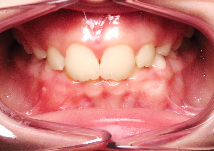 徐州儿童牙齿矫正牙齿不齐,大连口腔医院儿童牙齿矫正怎么样