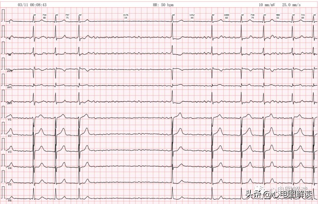 心房颤动伴长间歇心电图,心房颤动伴长间歇是什么意思