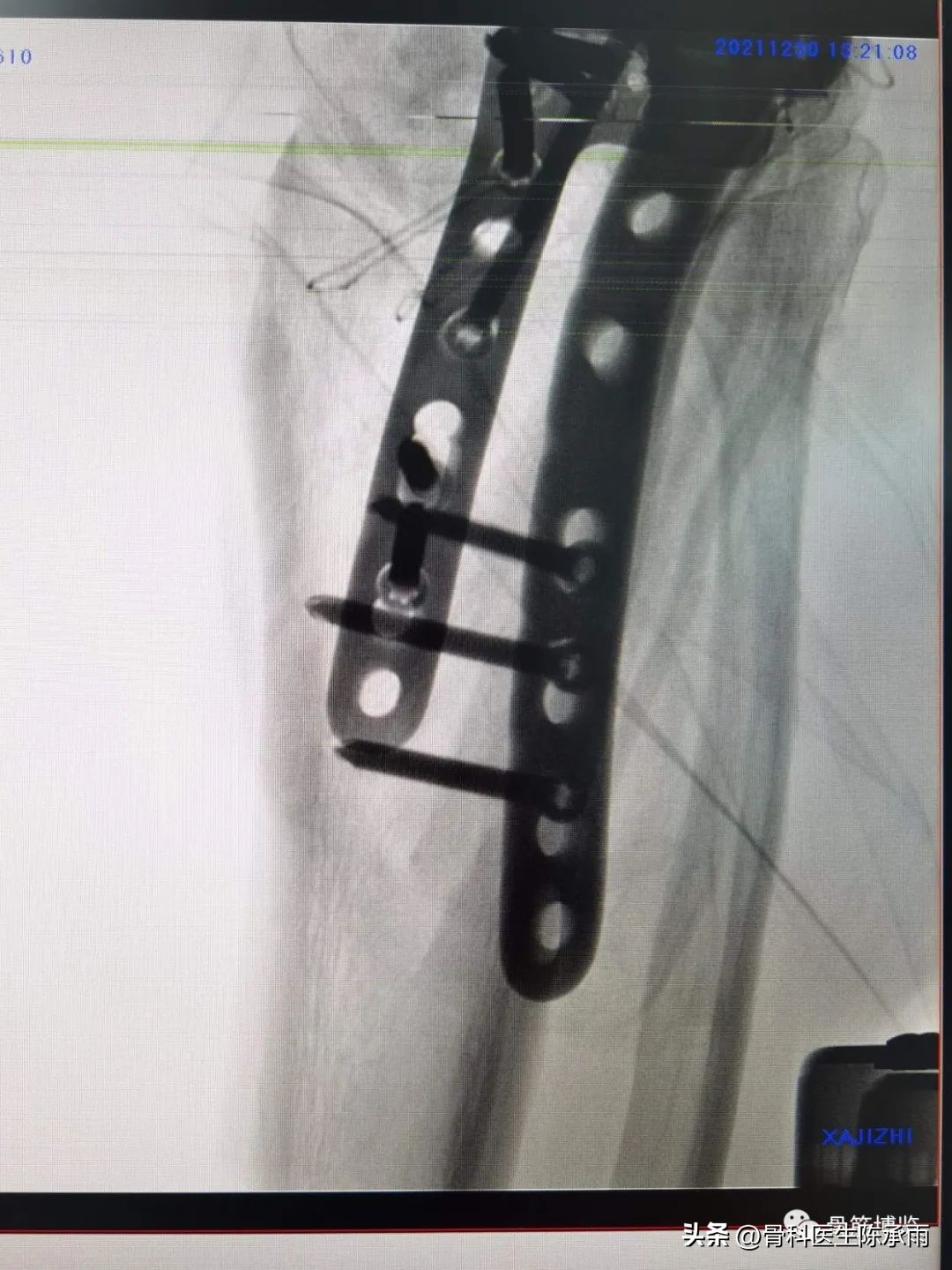 膝关节胫骨平台骨折,最近胫骨平台骨折视频