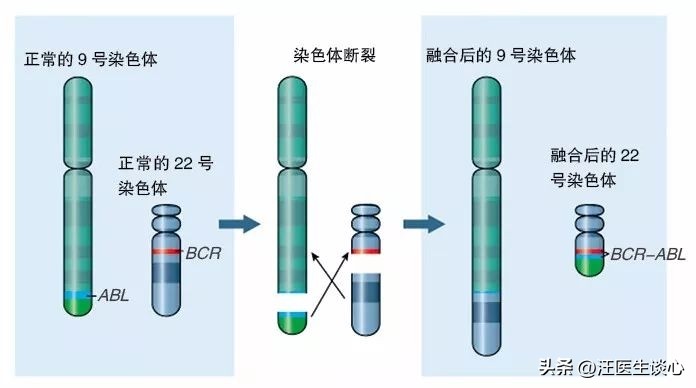 费城染色体阳性的急性髓系白血病,慢性粒细胞白血病的染色体标记