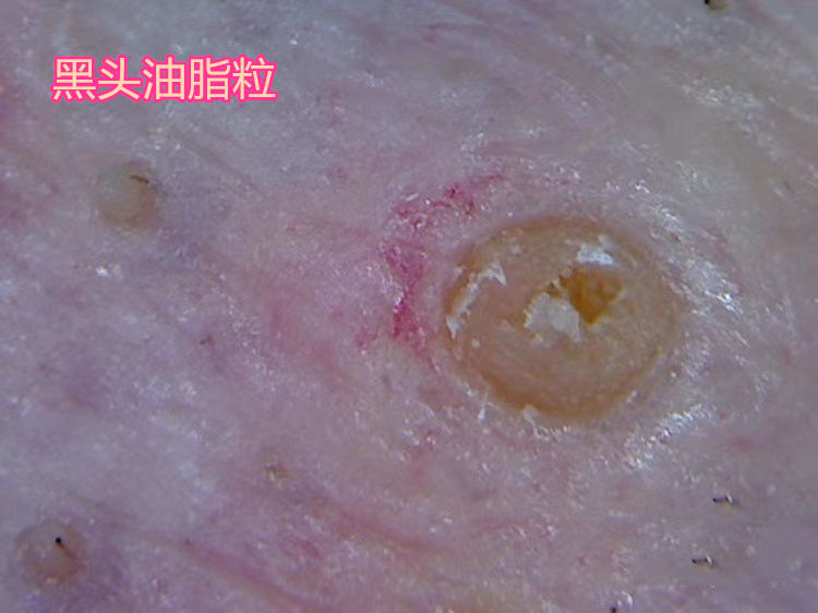 额头眉心发红有闭口粉刺,眉心鼻头频繁起粉刺怎么办