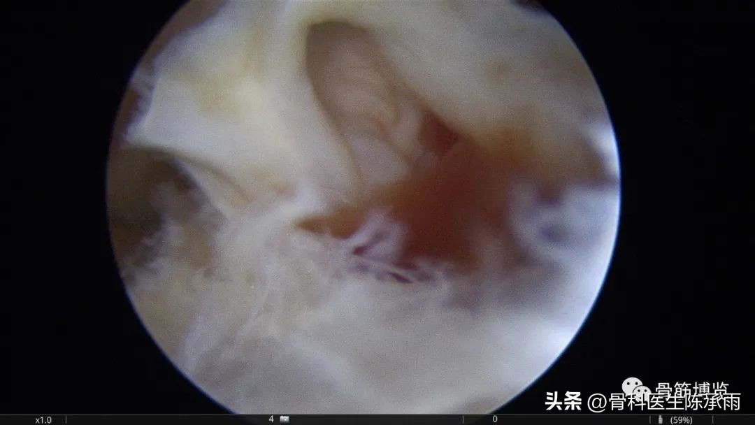 内侧半月板前角囊肿,关节镜下内侧半月板部分切除术