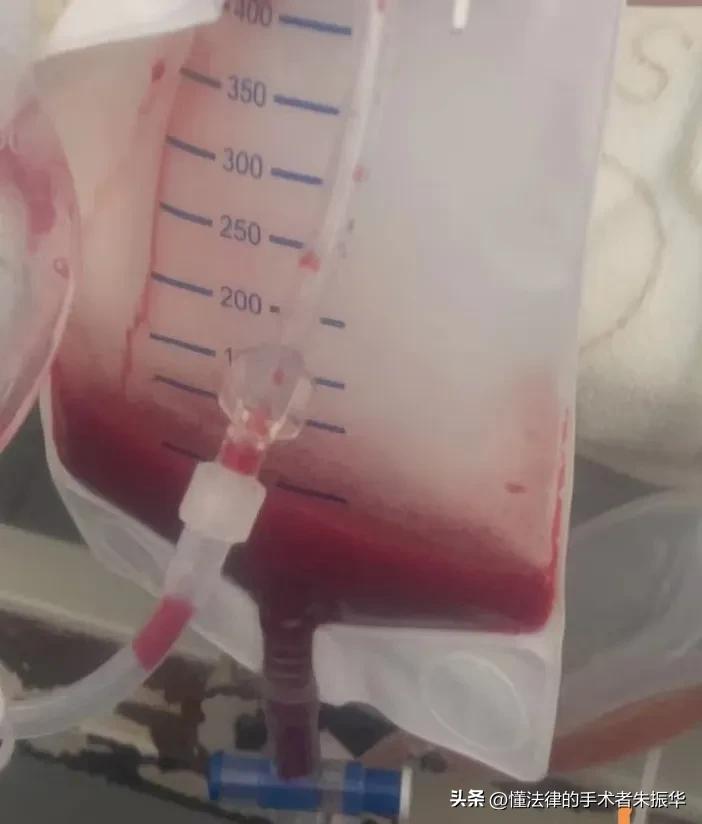 手术后出血一定要谨慎处理