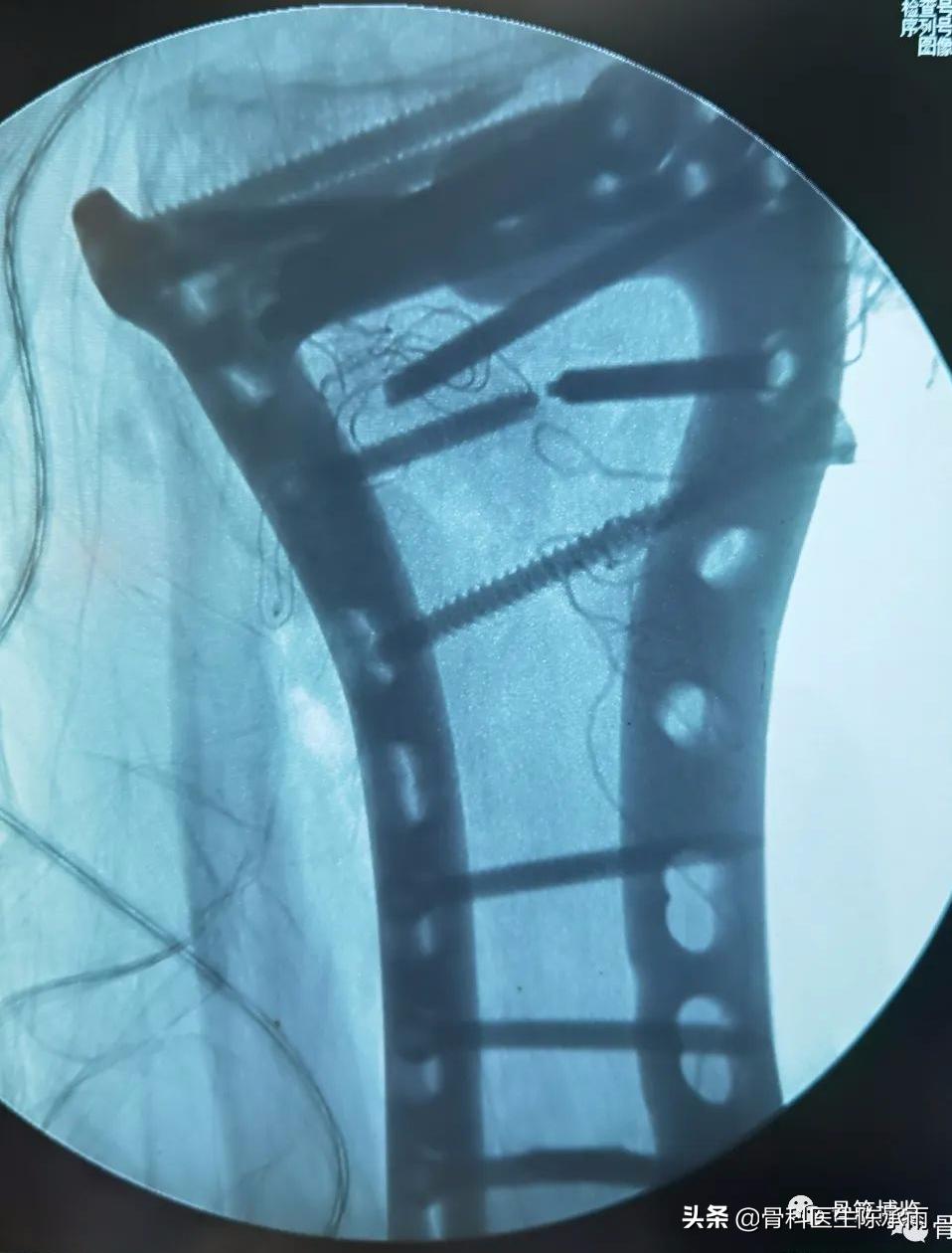 陈旧性腿骨骨折,陈旧性骨折