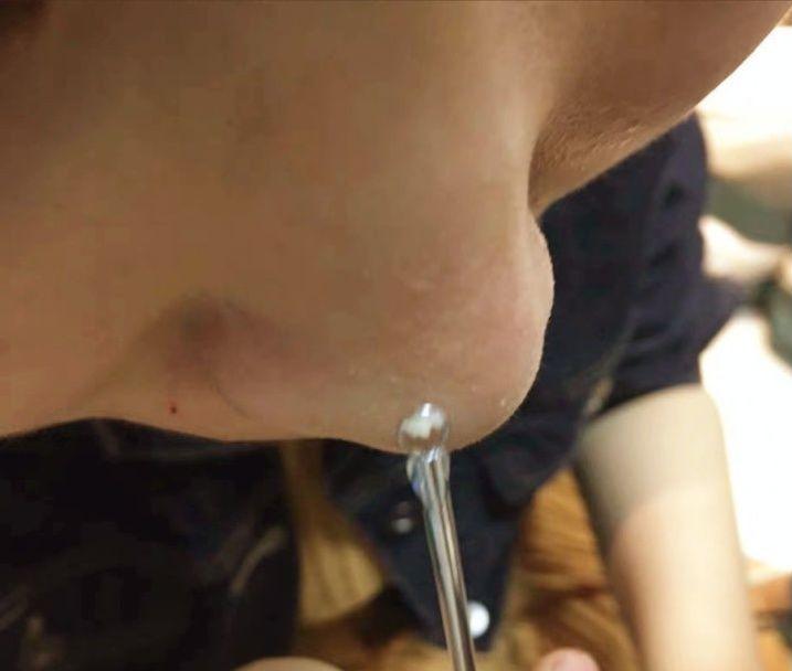 鼻子上有白白的小点可以挤吗,鼻子上黑黑的小点点怎么去除