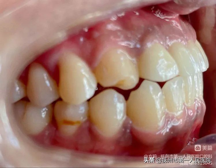 种植牙可修复多种牙齿缺失类型,学科建设口腔科