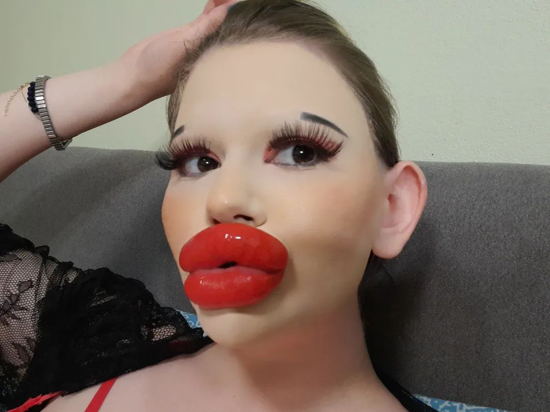 女子狂打30支玻尿酸,丰唇针建议打吗